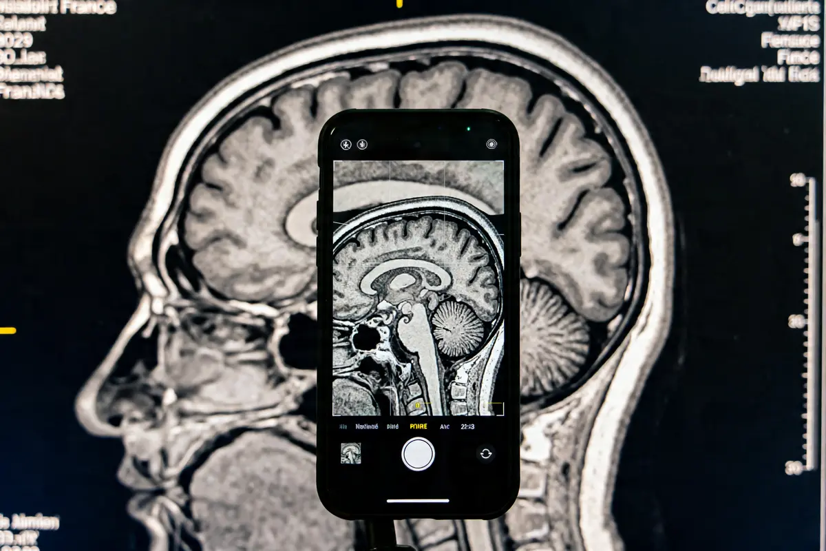 IRM cérébrale avec smartphone illustrant une atrophie hippocampique visible à l'écran