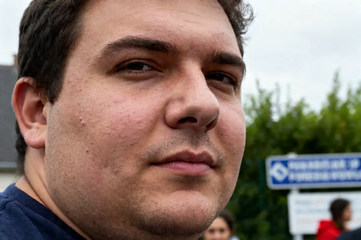 Homme avec cellulite de la face sur fond extérieur flou sans détails ajoutés