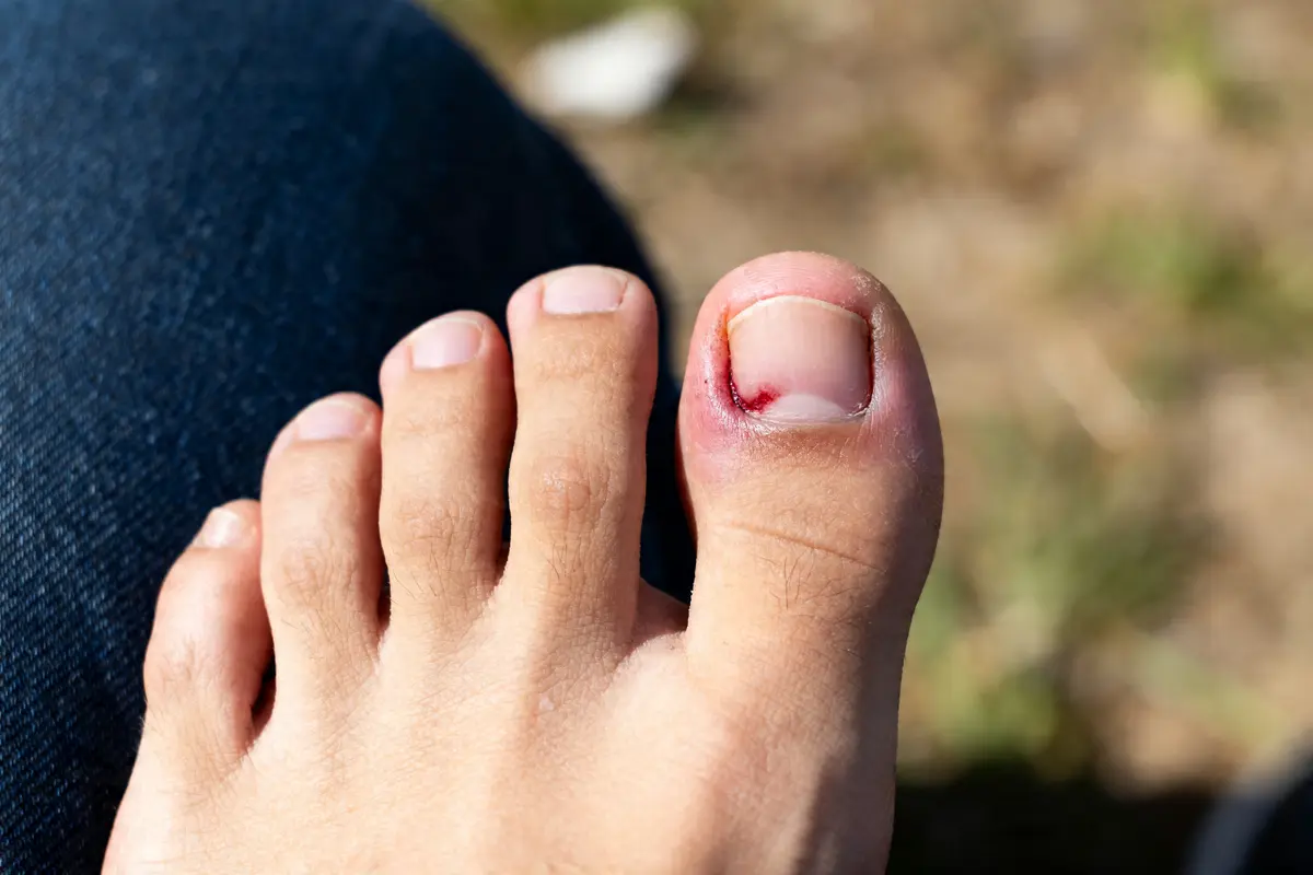 Fracture du gros orteil : symptômes, traitements et que faire ?