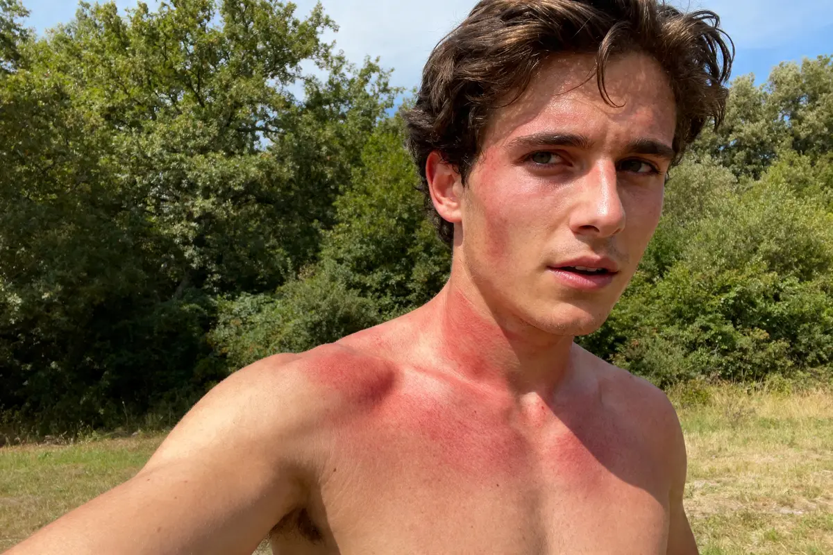 Homme torse nu avec hyperhémie due au soleil en plein air devant des arbres