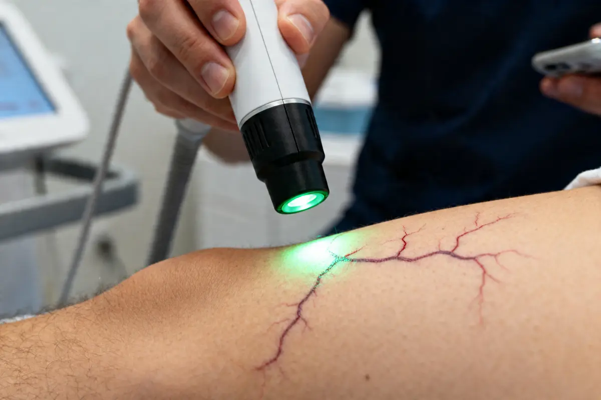pexels-michal-pech-213601-757318 (1) Application d'un laser vasculaire sur une jambe pour traiter des varicosités rouges