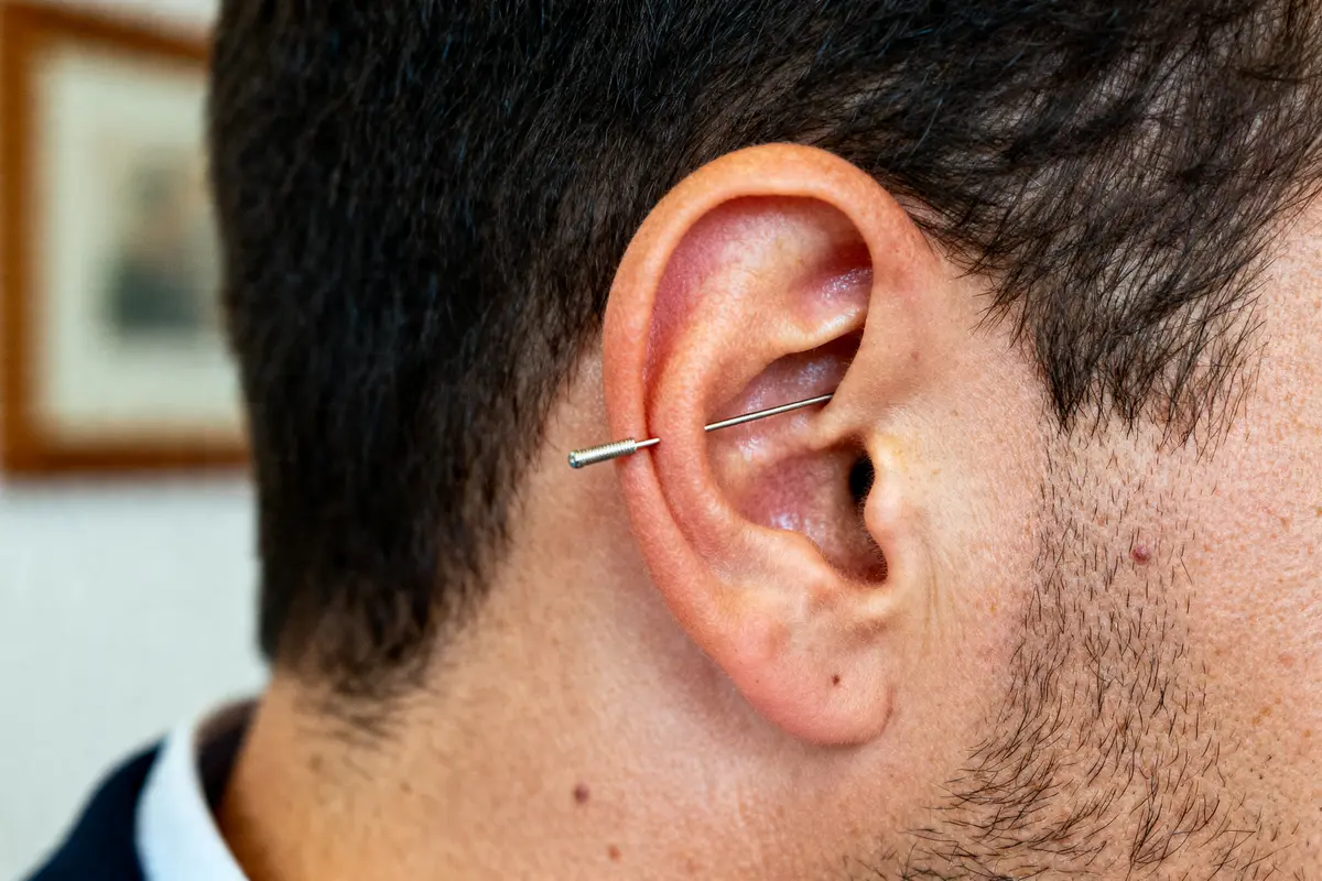 pexels-michal-pech-213601-757318 (1) Gros plan sur un point d'acupuncture à l'oreille avec une aiguille insérée