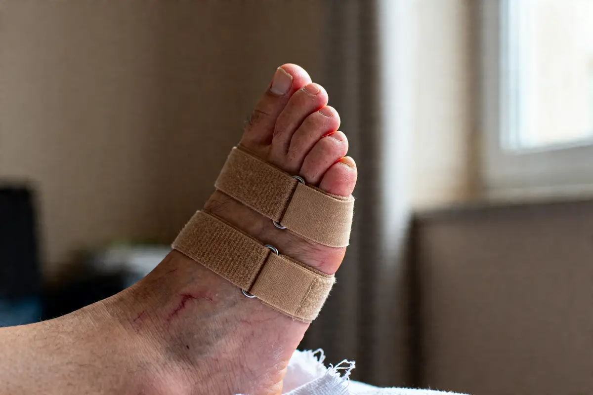 Pied avec deux attelles pour orteil blessé, que faire pour un orteil cassé